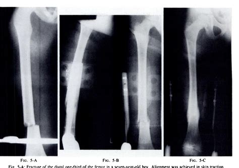 Figure From Functional Fracture Bracing Of Long Bone Fractures Of The