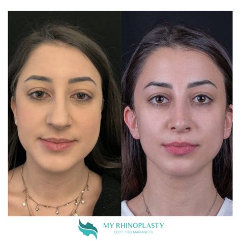 Naso A Patata La Chirurgia Per Correggerlo My Rhinoplasty