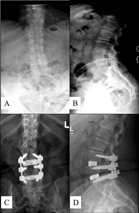 Preoperative Anteroposterior Ap A And Lateral B Radiographs And