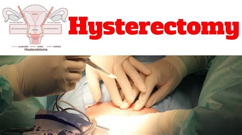 Hysterectomy Nucleus Health Hysterectomy Youtube Uterus