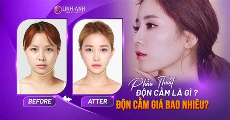 Độn cằm giá bao nhiêu Bảng giá độn cằm V line 2024