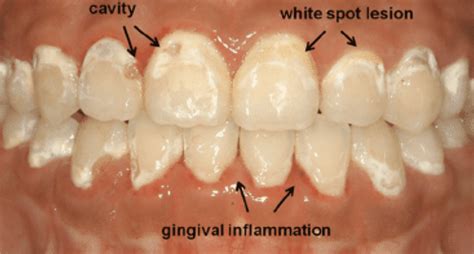 Braces Cause Teeth Stains How To Prevent Them