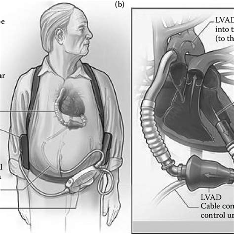 8 A Schematic Of An Implantable Left Ventricular Assist Device