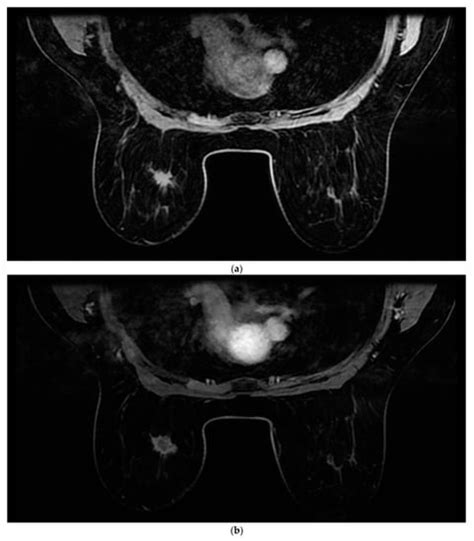 Cancers Free Full Text Diagnostic And Practical Value Of Abbreviated Contrast Enhanced