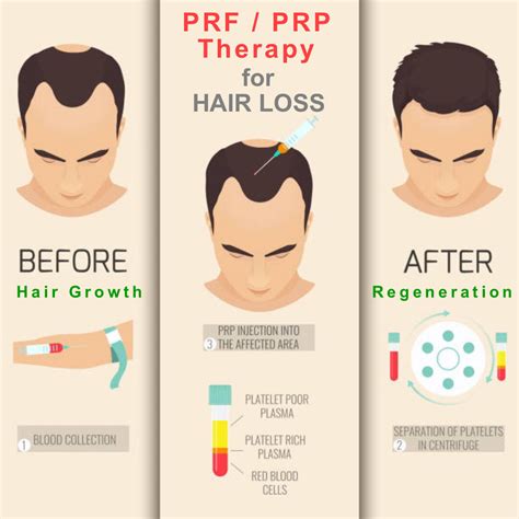 PRP / PRF Hair Growth Restoration In Los Angeles & Glendale, CA