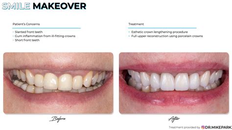 Before And After Photos Smile Makeover Gallery Clear Dental