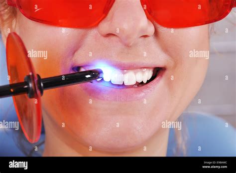 Filling Tooth Ultraviolet Lamp Close Up Stock Photo Alamy