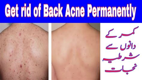 Back Acne Get Acne Free Clear Back Magical Remedy For Back Acne Acne Free Back Healthcare