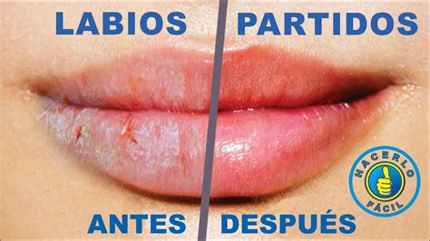 Arriba Imagen Receta Casera Para Labios Resecos Abzlocal Mx