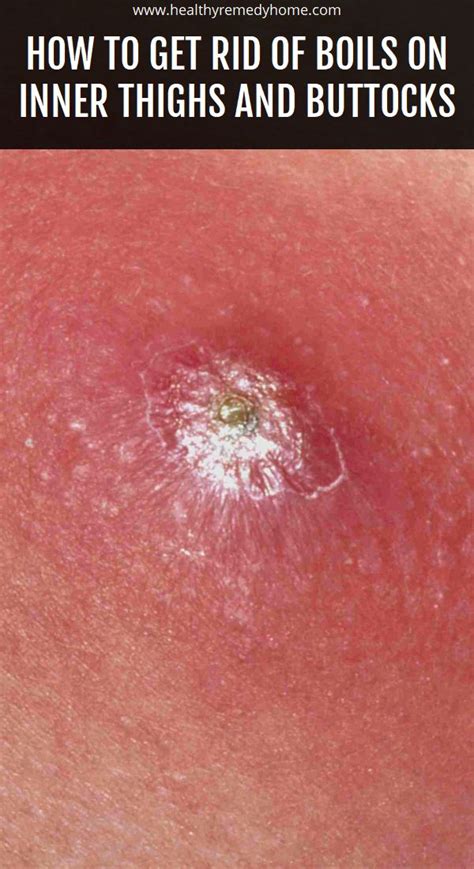 What Causes A Boil On Inner Thigh At Pedro Casale Blog