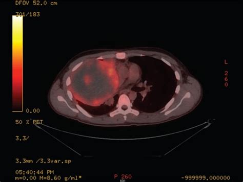 A Whole Body Combined F Fluorodeoxyglucose Fdg Positron Emission