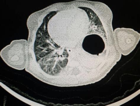 La Hernie Diaphragmatique Cong Nitale Une Pathologie Pas Toujours