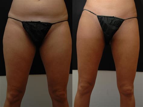 Body Contouring With Coolsculpting Before And After Dr Jeffrey Wise