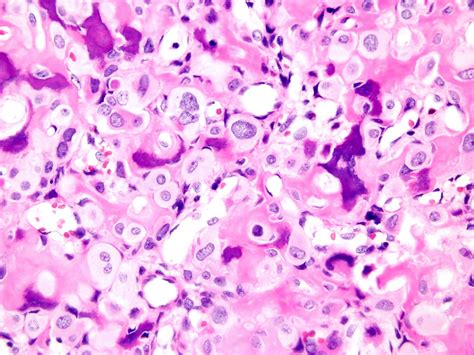 Chondroblastoma Pathology Outlines