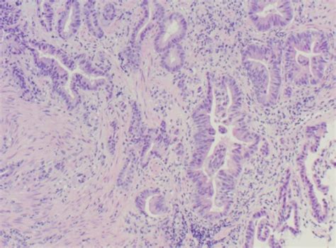 Lung Pathology 2 Neoplasia Flashcards Quizlet