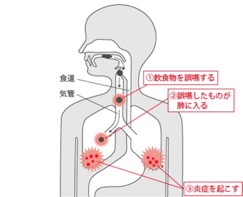 誤嚥性肺炎とは バランス株式会社