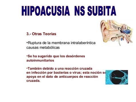 Hipoacusia Subita