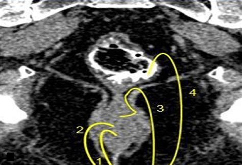 Types of Fistula's and possible treatments' | Fistulizing Perianal ...