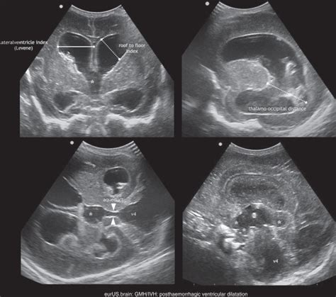 Cranial Ultrasound Findings In Preterm Germinal Matrix Haemorrhage