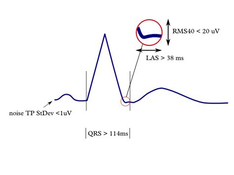 File Late Potentials Png Ecgpedia