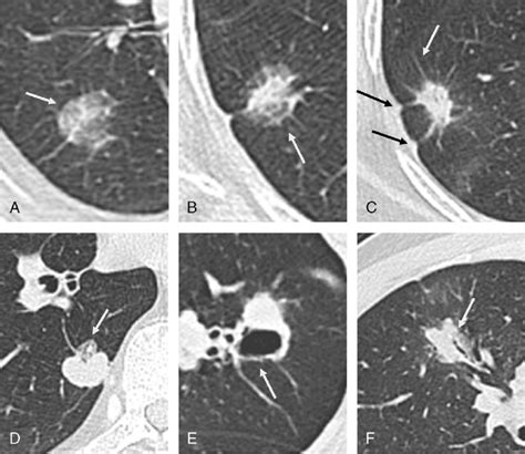 Typical Morphological Features Of Lung Adenocarcinomas On Ct Images A Download Scientific