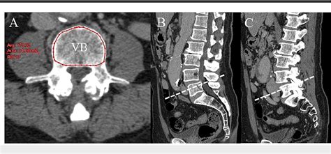 Figure From The Quantity And Quality Of Lumbar Muscles And