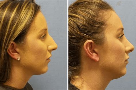 How Long Does Rhinoplasty Take To Heal What You Need To Know