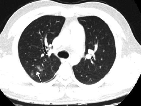 Patient 2 Chest Computed Tomography On Admission Mild Ground Glass Download Scientific