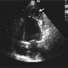 Transthoracic Echocardiographic Apical Four Chamber View Showing The