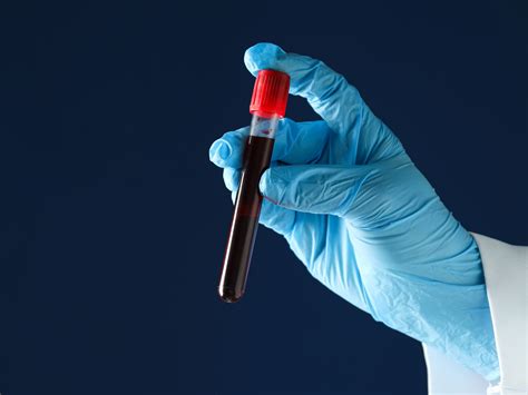 Will a new colon cancer blood test replace your colonoscopy? | National