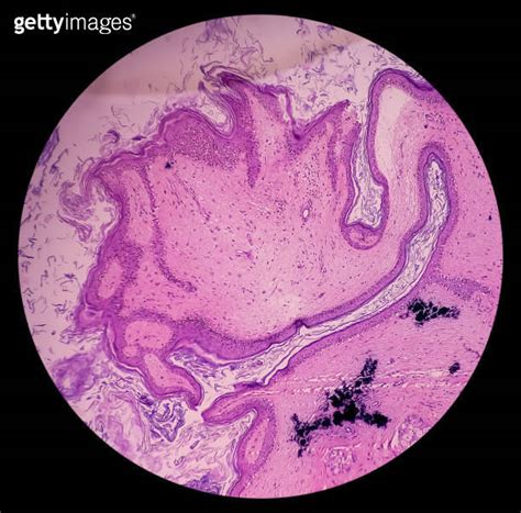 Mature Cystic Teratoma Ovarian Cyst Biopsy Show Cyst Wall Of Skin And