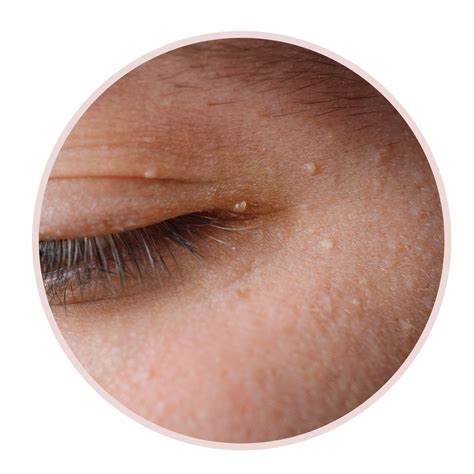 6 Forms Of Eyelid Bumps And How You Can Treat Them In Keeping With Dermatologists Beautifaire