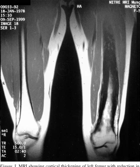 Figure 1 From Chronic Diffuse Sclerosing Osteomyelitis Treated With