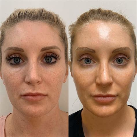 Transform Your Skin With Prp Explore Prp Before And After