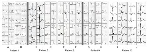 Twelve Lead Electrocardiograms During Pre Excitation A C E G I And Download Scientific