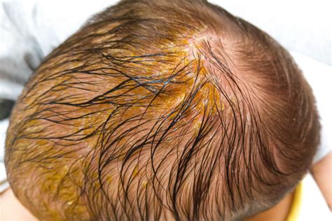 Cradle Cap In Babies Being The Parent