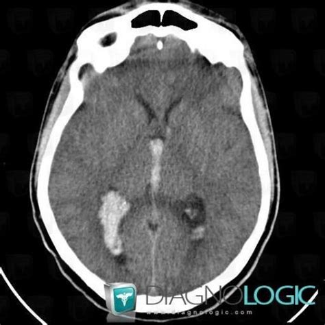 Radiology case : Intraventricular hemorrhage (CT ,MRI) - Diagnologic