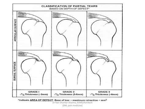 Diagnostic Ultrasound Of Shoulder Ppt