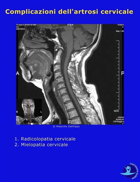 Artrosi Cervicale i Sintomi Reali e la Terapia più Efficace