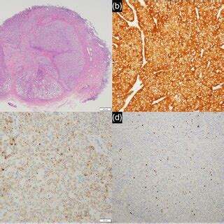 Histological And Immunohistochemical Findings Of The Resected Specimen