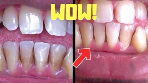 How To Remove Brown Stains On Teeth Comfortably At Home Mouth Ninja