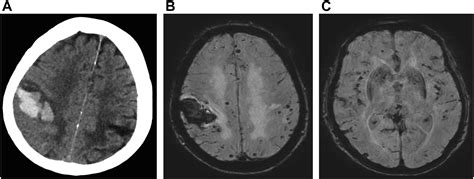 Cerebral Amyloid Angiopathy Radiologic Clinics