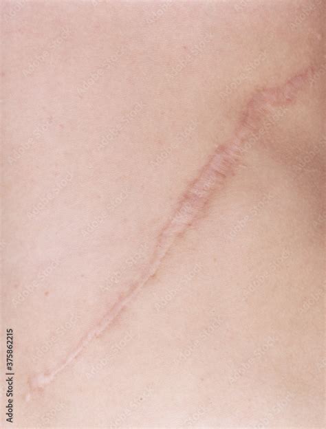 scar stock photo adobe stock