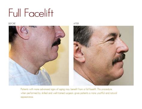 Full Facelift Drake And Presti Ent Surgical Associates