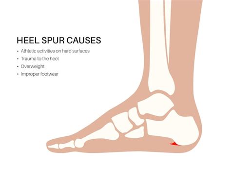 Premium Vector Calcaneal Spur Causes Foot Problem Diagnostic And Treatment In Podiatry Clinic