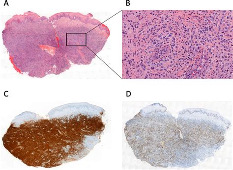 Histological examination of the deep and large cervical biopsy. A (H&E ...