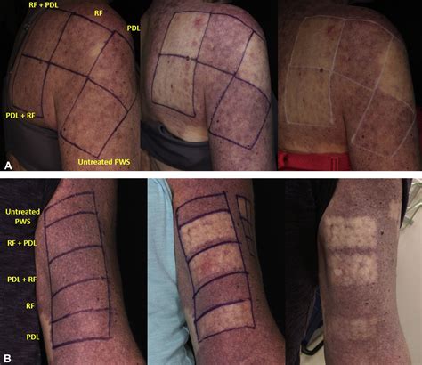 Treatment Of Recalcitrant Port Wine Stains Pws Using A Combined Pulsed Dye Laser Pdl And