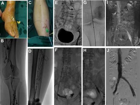 A Retrospective Study Comparing Pharmacomechanical Thrombectomy With