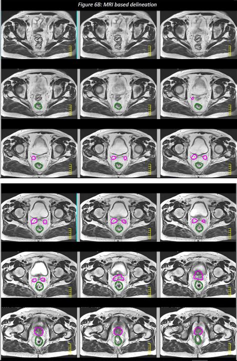 Estro Acrop Consensus Guideline On Ct And Mri Based Target Volume