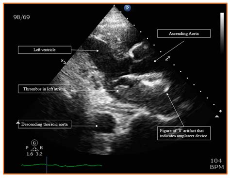 Figure 1 Parasternal Long Axis View Of The Transthoracic